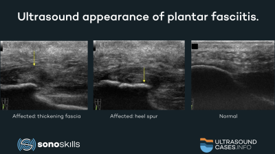 Comparing ultrasound with MRI and CT in measuring the plantar fascia